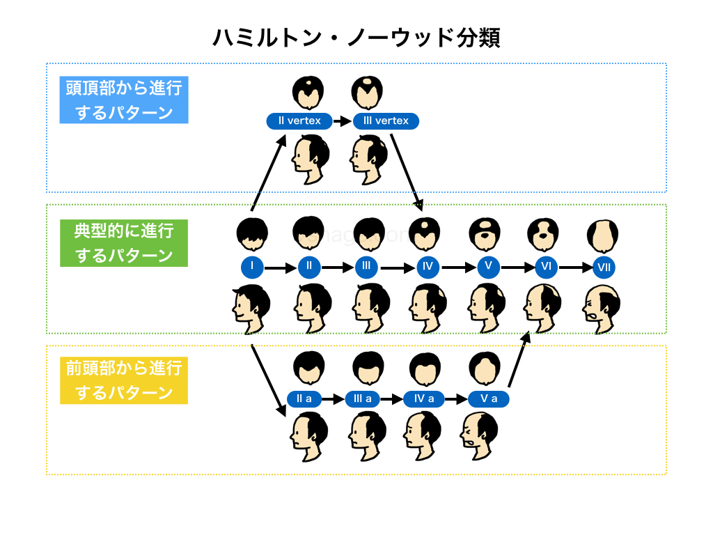 ハミルトン・ノーウッド分類(進行パターン)